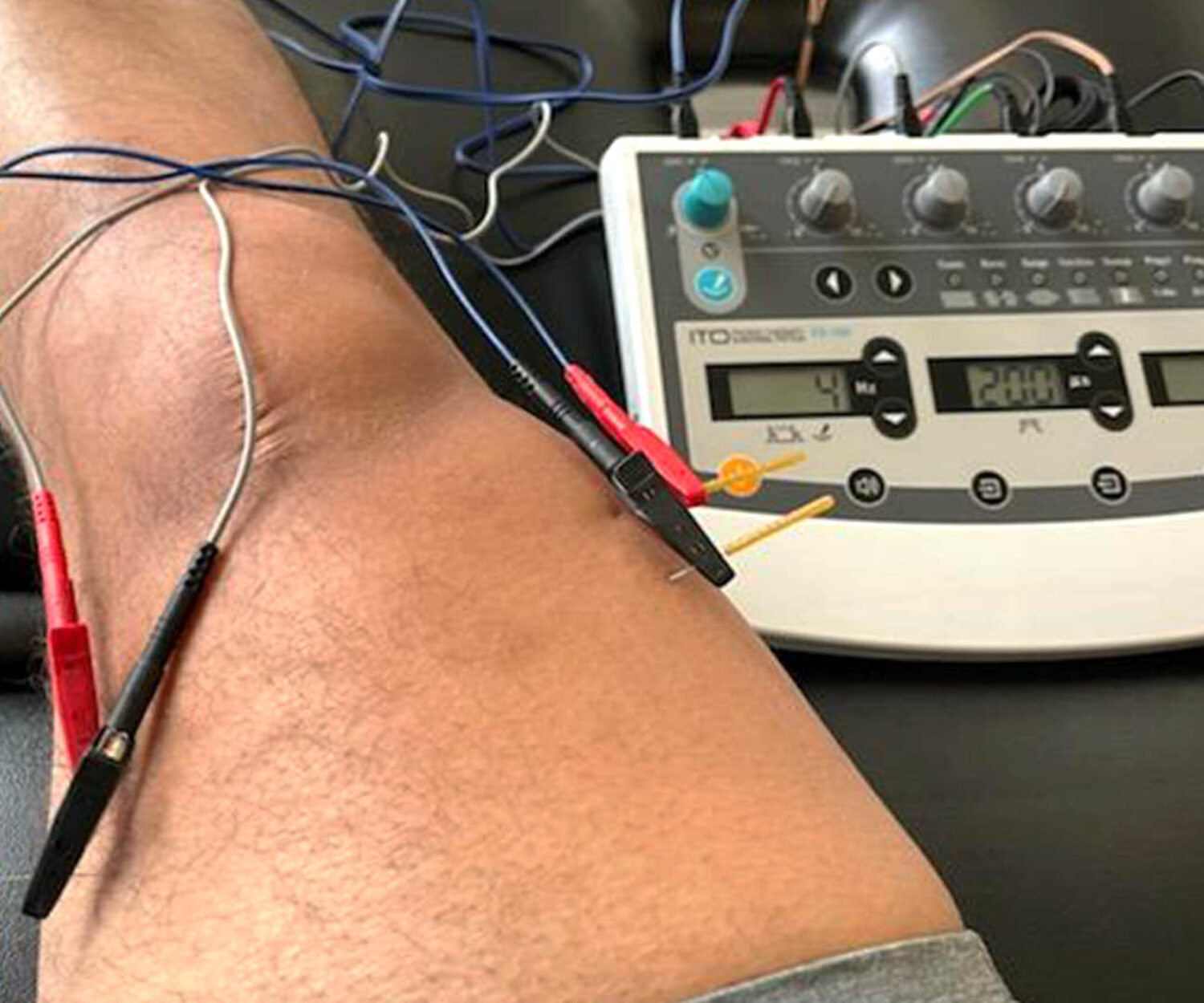 Fox Physical Therapy Dry Needling DN Miami