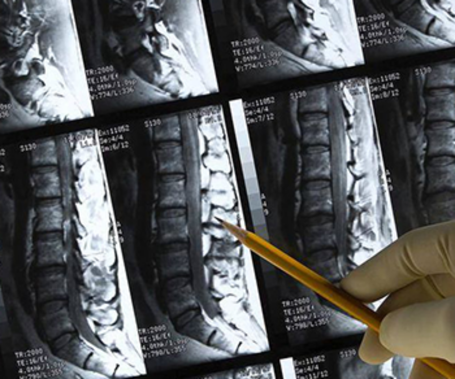 the-truth-about-mri-and-backpain