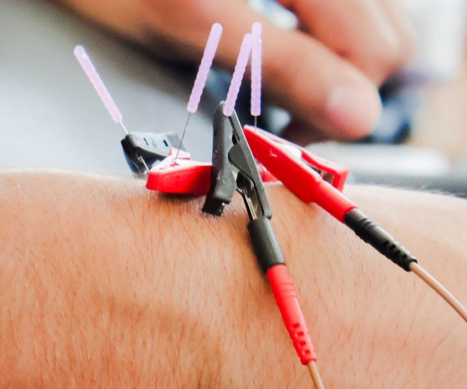 dry needling therapy miami