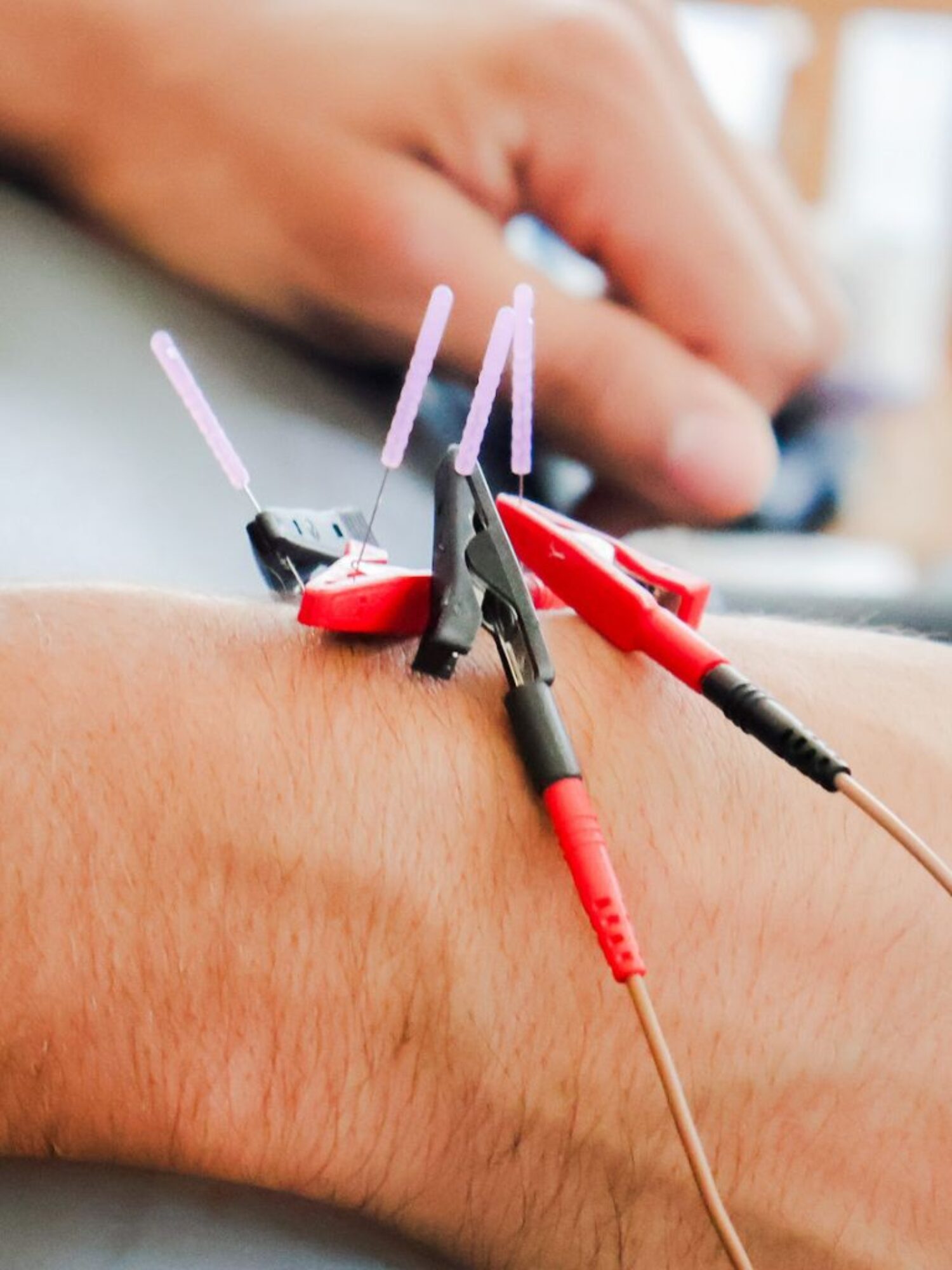 dry needling therapy miami